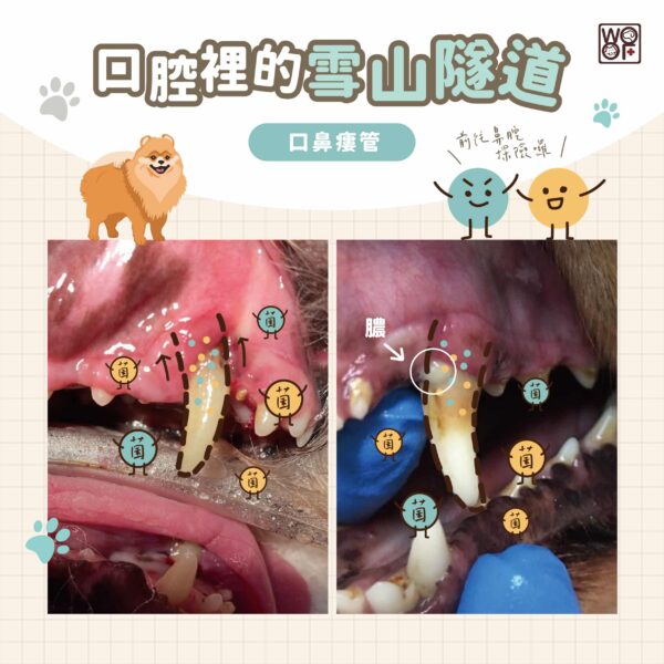 口鼻瘻管就像牙周病的隧道，將細菌由牙周病的發源地帶往鼻腔，進而導致更嚴重的感染。